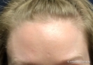 Botox (forehead)