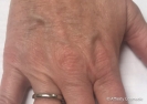 Icon Laser (hyperpigmentation treatment on hands) 