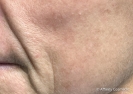 Icon Laser (hyperpigmentation treatment on face)